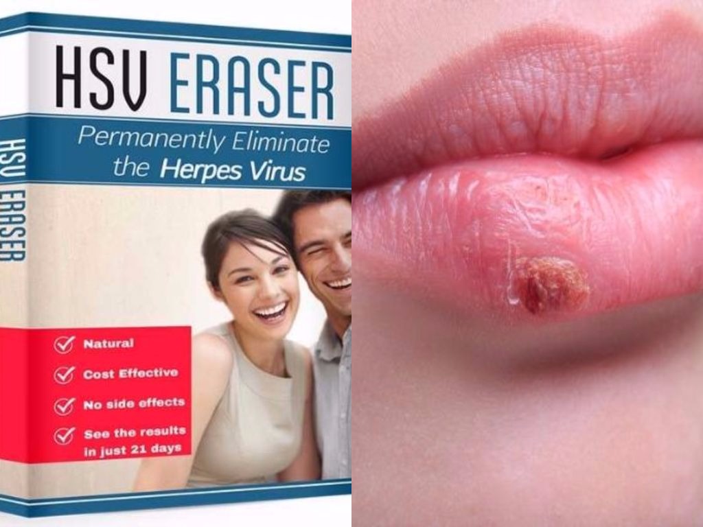 Herpes Erased Review